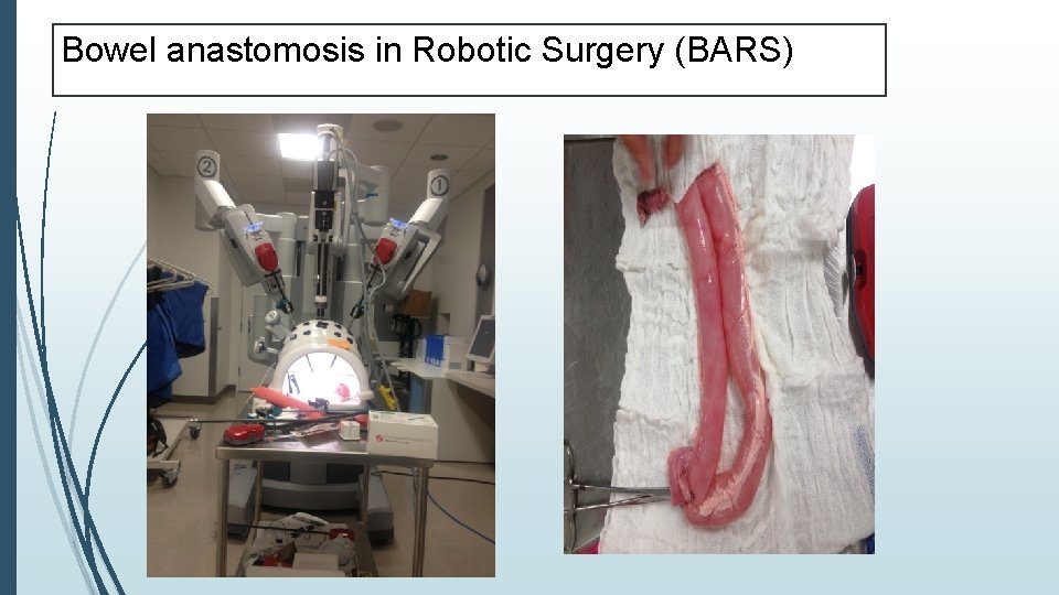 Bowel anastomosis in Robotic Surgery (BARS) 
