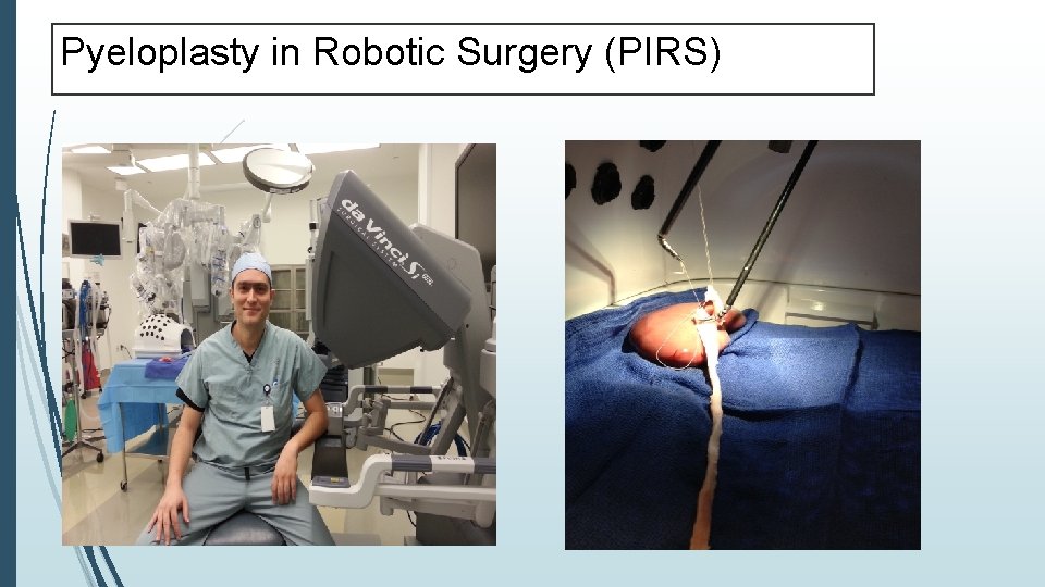 Pyeloplasty in Robotic Surgery (PIRS) 