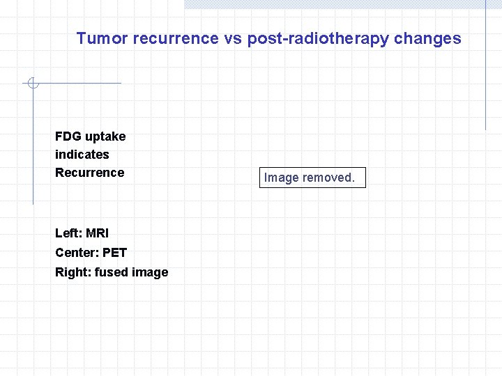 Tumor recurrence vs post-radiotherapy changes FDG uptake indicates Recurrence Left: MRI Center: PET Right: