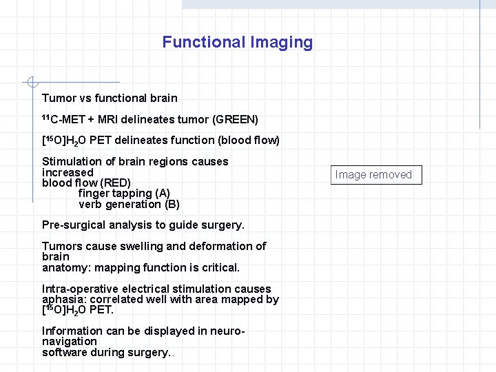 Functional Imaging Tumor vs functional brain 11 C-MET + MRI delineates tumor (GREEN) [15