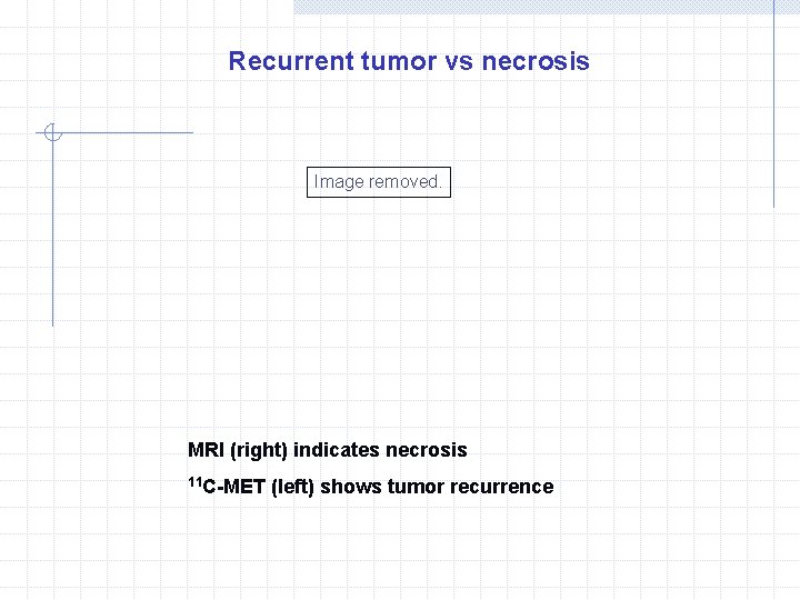 Recurrent tumor vs necrosis Image removed. MRI (right) indicates necrosis 11 C-MET (left) shows