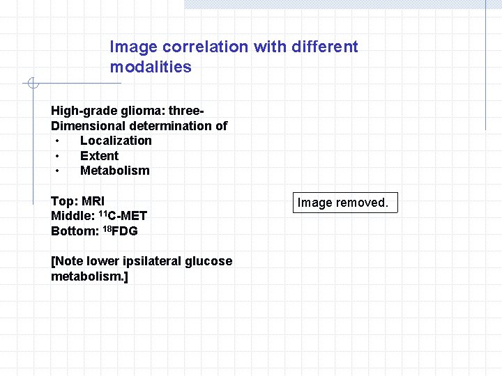 Image correlation with different modalities High-grade glioma: three. Dimensional determination of ‧ Localization ‧