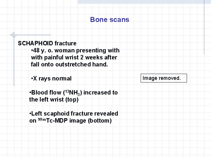 Bone scans SCHAPHOID fracture • 48 y. o. woman presenting with painful wrist 2