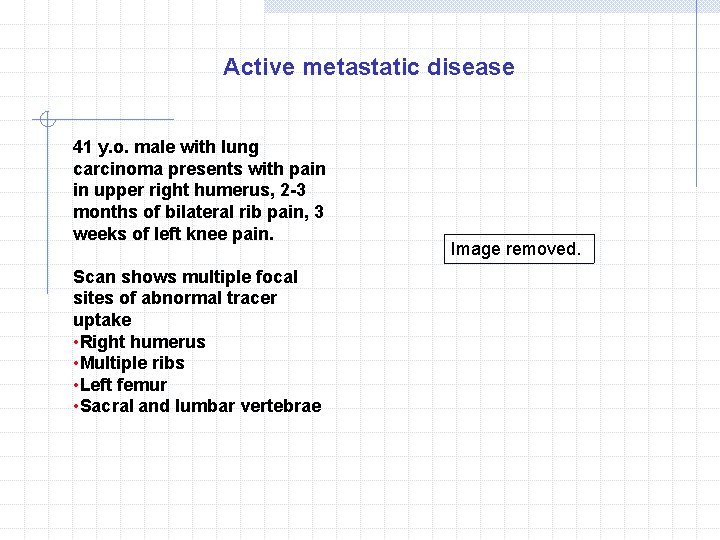 Active metastatic disease 41 y. o. male with lung carcinoma presents with pain in