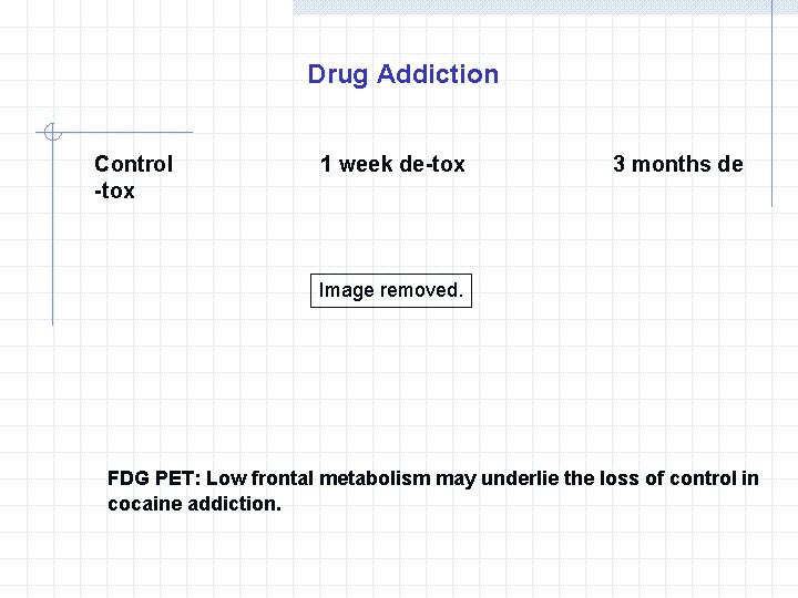 Drug Addiction Control -tox 1 week de-tox 3 months de Image removed. FDG PET: