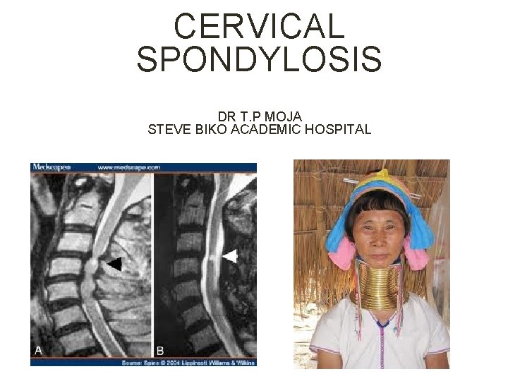 CERVICAL SPONDYLOSIS DR T. P MOJA STEVE BIKO ACADEMIC HOSPITAL 