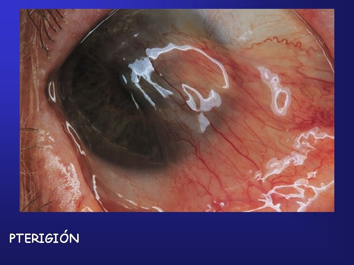 PTERIGIÓN 