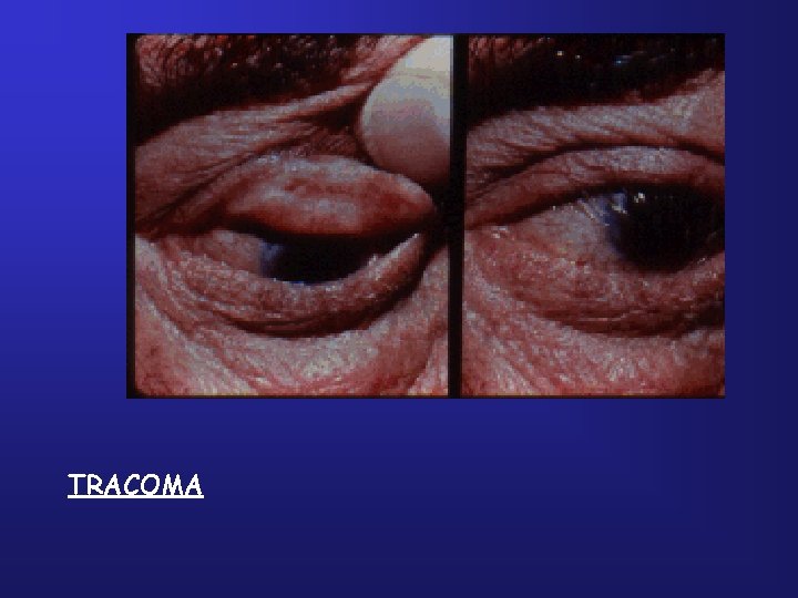 TRACOMA 