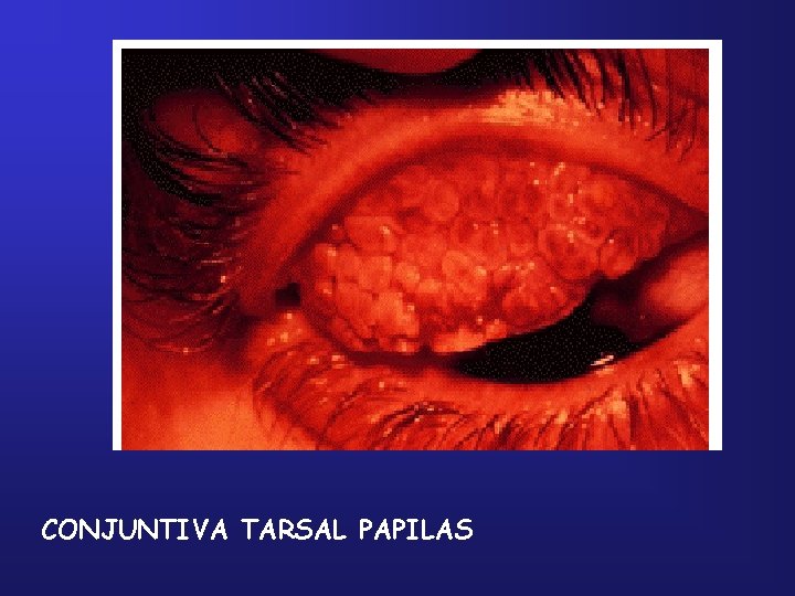 CONJUNTIVA TARSAL PAPILAS 