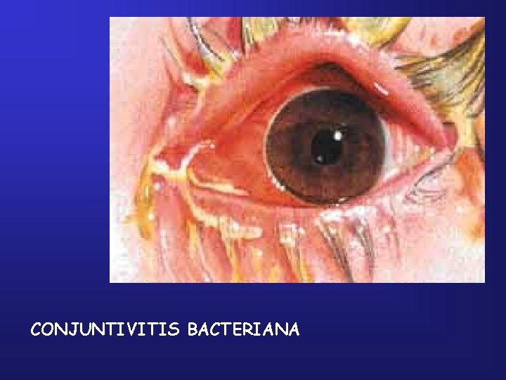 CONJUNTIVITIS BACTERIANA 