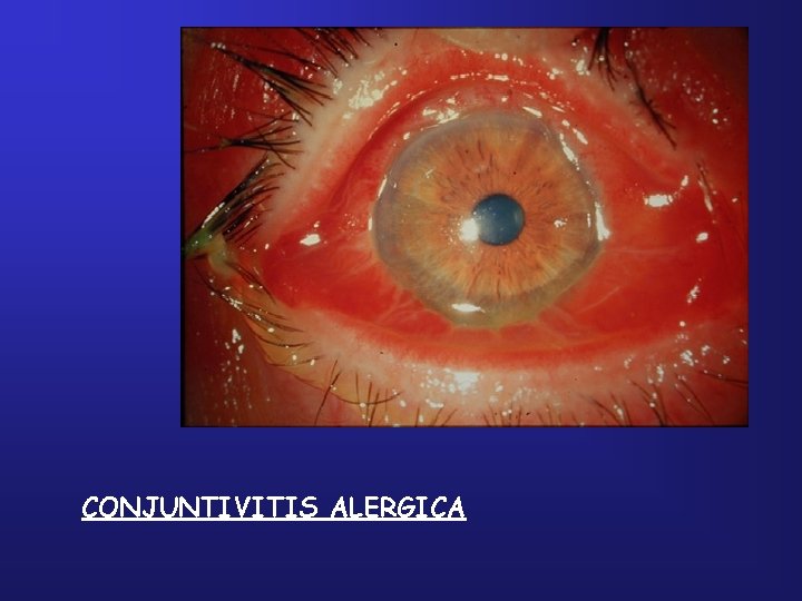 CONJUNTIVITIS ALERGICA 