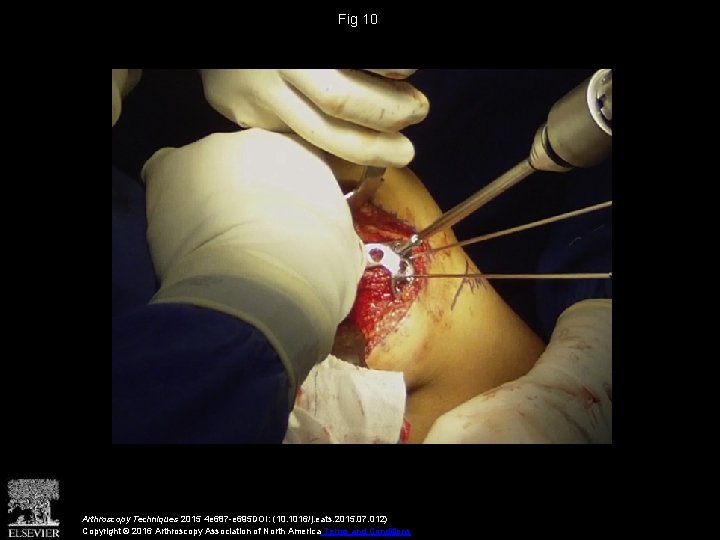 Fig 10 Arthroscopy Techniques 2015 4 e 687 -e 695 DOI: (10. 1016/j. eats. Fig 10 Arthroscopy Techniques 2015 4 e 687 -e 695 DOI: (10. 1016/j. eats.