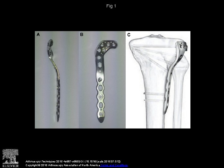 Fig 1 Arthroscopy Techniques 2015 4 e 687 -e 695 DOI: (10. 1016/j. eats. Fig 1 Arthroscopy Techniques 2015 4 e 687 -e 695 DOI: (10. 1016/j. eats.