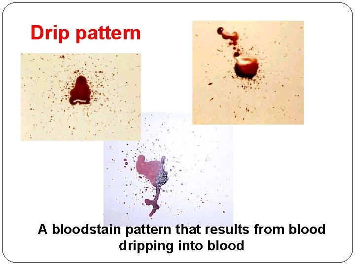 Drip pattern A bloodstain pattern that results from blood dripping into blood 