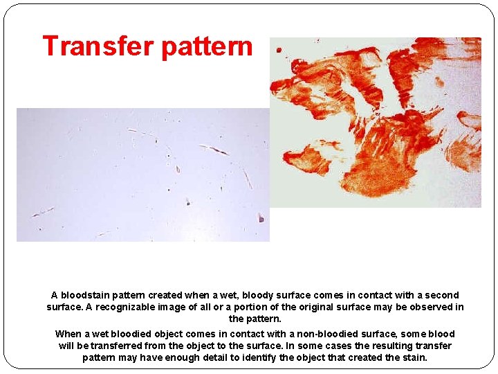 Transfer pattern A bloodstain pattern created when a wet, bloody surface comes in contact