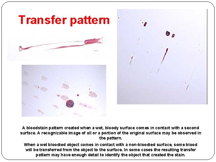 Transfer pattern A bloodstain pattern created when a wet, bloody surface comes in contact