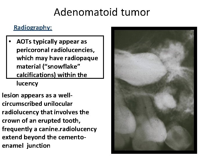 Adenomatoid tumor Radiography: • AOTs typically appear as pericoronal radiolucencies, which may have radiopaque Adenomatoid tumor Radiography: • AOTs typically appear as pericoronal radiolucencies, which may have radiopaque