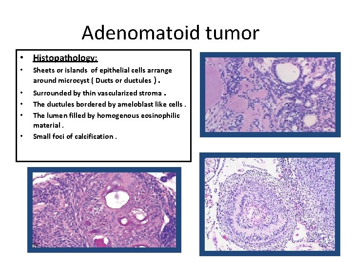 Adenomatoid tumor • Histopathology: • Sheets or islands of epithelial cells arrange around microcyst Adenomatoid tumor • Histopathology: • Sheets or islands of epithelial cells arrange around microcyst