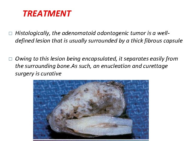 TREATMENT � Histologically, the adenomatoid odontogenic tumor is a welldefined lesion that is usually TREATMENT � Histologically, the adenomatoid odontogenic tumor is a welldefined lesion that is usually