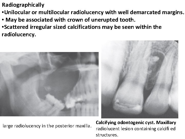 Radiographically • Unilocular or multilocular radiolucency with well demarcated margins. • May be associated Radiographically • Unilocular or multilocular radiolucency with well demarcated margins. • May be associated