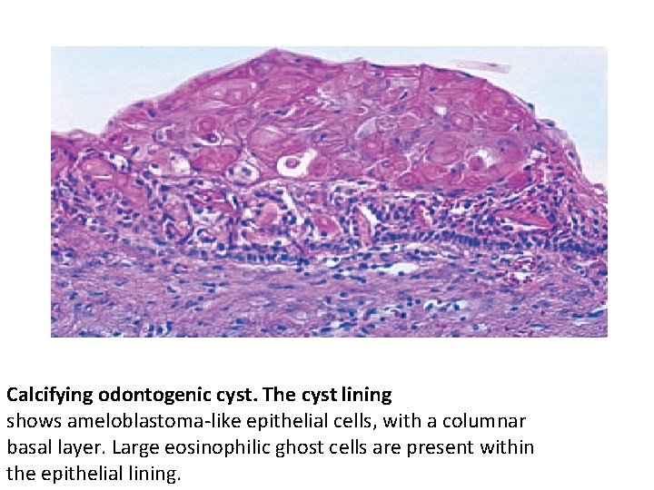 Calcifying odontogenic cyst. The cyst lining shows ameloblastoma-like epithelial cells, with a columnar basal Calcifying odontogenic cyst. The cyst lining shows ameloblastoma-like epithelial cells, with a columnar basal