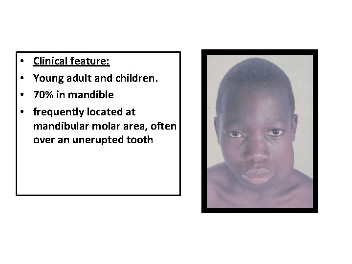 • • Clinical feature: Young adult and children. 70% in mandible frequently located • • Clinical feature: Young adult and children. 70% in mandible frequently located
