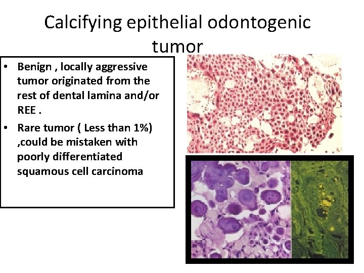 Calcifying epithelial odontogenic tumor • Benign , locally aggressive tumor originated from the rest Calcifying epithelial odontogenic tumor • Benign , locally aggressive tumor originated from the rest
