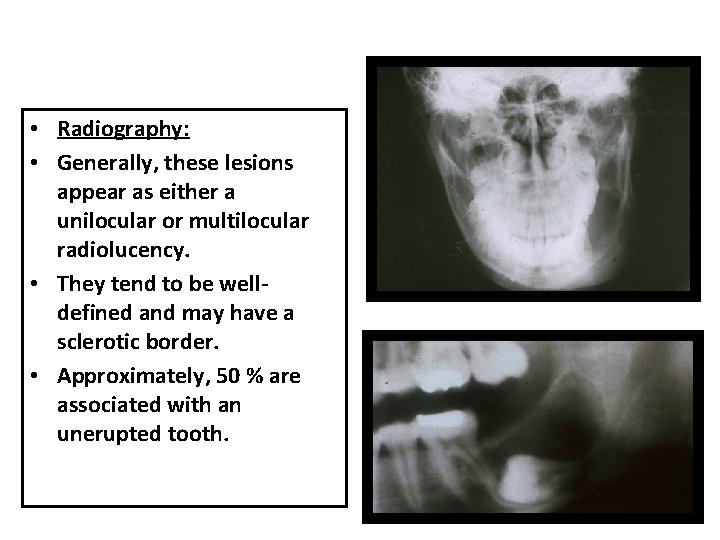 • Radiography: • Generally, these lesions appear as either a unilocular or multilocular • Radiography: • Generally, these lesions appear as either a unilocular or multilocular