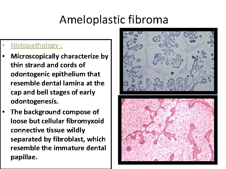 Ameloplastic fibroma • Histopathology : • Microscopically characterize by thin strand cords of odontogenic Ameloplastic fibroma • Histopathology : • Microscopically characterize by thin strand cords of odontogenic