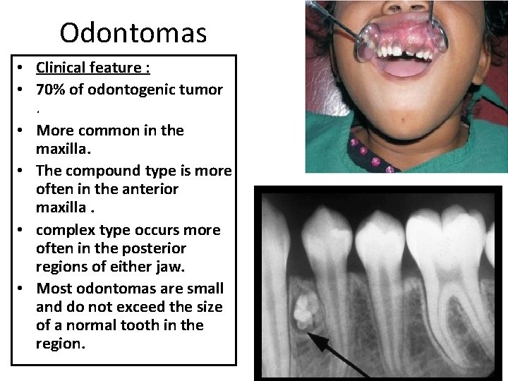 Odontomas • Clinical feature : • 70% of odontogenic tumor. • More common in Odontomas • Clinical feature : • 70% of odontogenic tumor. • More common in
