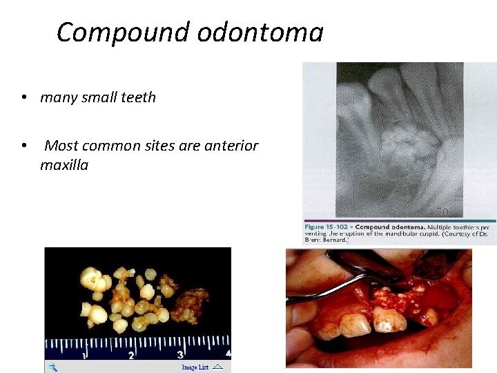 Compound odontoma • many small teeth • Most common sites are anterior maxilla Compound odontoma • many small teeth • Most common sites are anterior maxilla