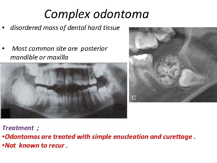 Complex odontoma • disordered mass of dental hard tissue • Most common site are Complex odontoma • disordered mass of dental hard tissue • Most common site are