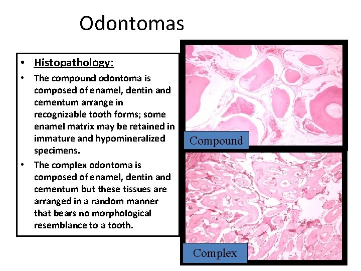 Odontomas • Histopathology: • The compound odontoma is composed of enamel, dentin and cementum Odontomas • Histopathology: • The compound odontoma is composed of enamel, dentin and cementum