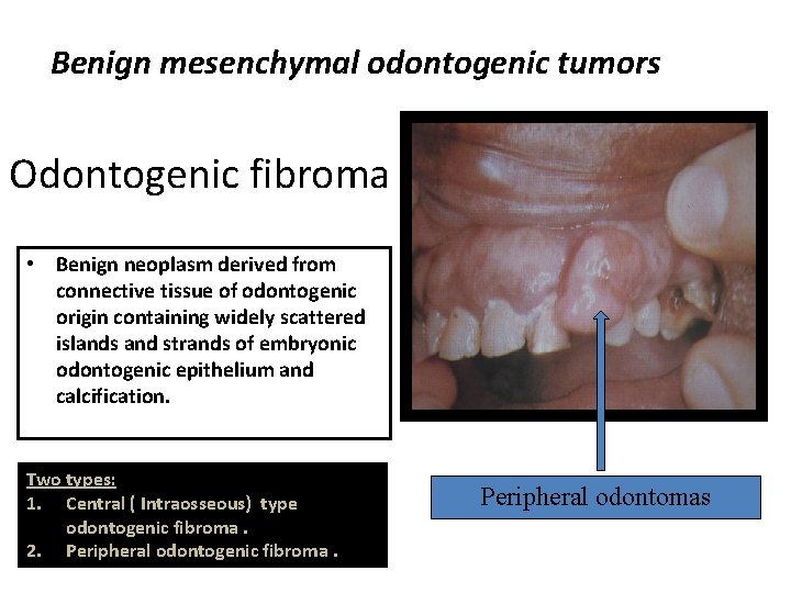 Benign mesenchymal odontogenic tumors Odontogenic fibroma • Benign neoplasm derived from connective tissue of Benign mesenchymal odontogenic tumors Odontogenic fibroma • Benign neoplasm derived from connective tissue of