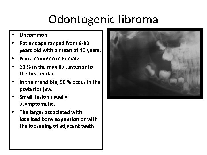 Odontogenic fibroma • Uncommon • Patient age ranged from 9 -80 years old with Odontogenic fibroma • Uncommon • Patient age ranged from 9 -80 years old with