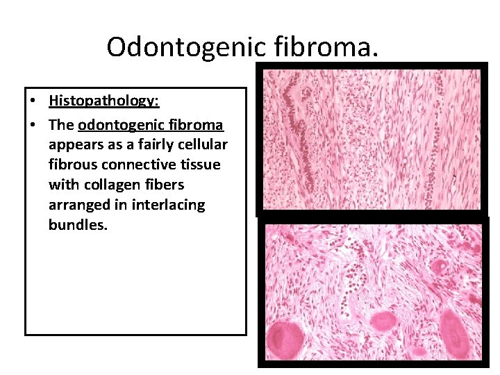Odontogenic fibroma. • Histopathology: • The odontogenic fibroma appears as a fairly cellular fibrous Odontogenic fibroma. • Histopathology: • The odontogenic fibroma appears as a fairly cellular fibrous