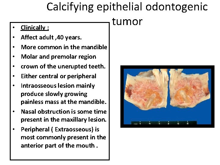 • • Calcifying epithelial odontogenic tumor Clinically : Affect adult , 40 years. • • Calcifying epithelial odontogenic tumor Clinically : Affect adult , 40 years.