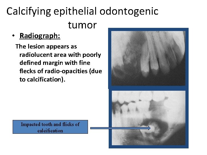 Calcifying epithelial odontogenic tumor • Radiograph: The lesion appears as radiolucent area with poorly Calcifying epithelial odontogenic tumor • Radiograph: The lesion appears as radiolucent area with poorly
