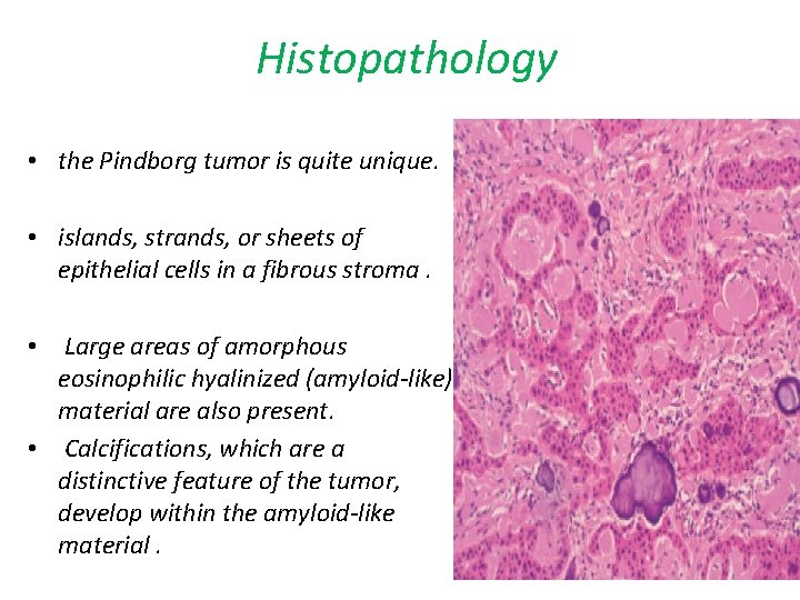Histopathology • the Pindborg tumor is quite unique. • islands, strands, or sheets of Histopathology • the Pindborg tumor is quite unique. • islands, strands, or sheets of