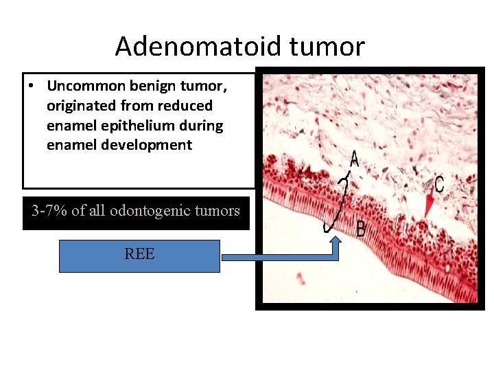 Adenomatoid tumor • Uncommon benign tumor, originated from reduced enamel epithelium during enamel development Adenomatoid tumor • Uncommon benign tumor, originated from reduced enamel epithelium during enamel development