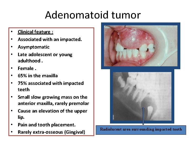 Adenomatoid tumor • • • Clinical feature : Associated with an impacted. Asymptomatic Late Adenomatoid tumor • • • Clinical feature : Associated with an impacted. Asymptomatic Late