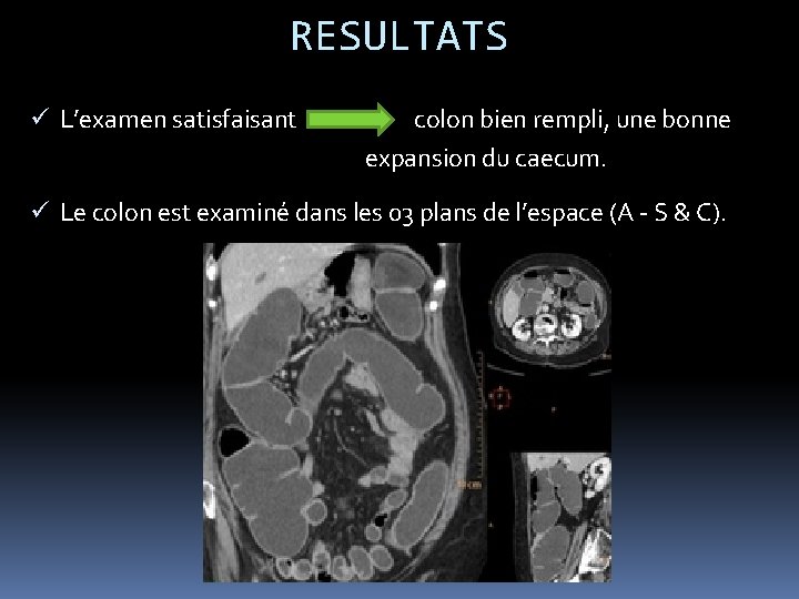 RESULTATS ü L’examen satisfaisant colon bien rempli, une bonne expansion du caecum. ü Le