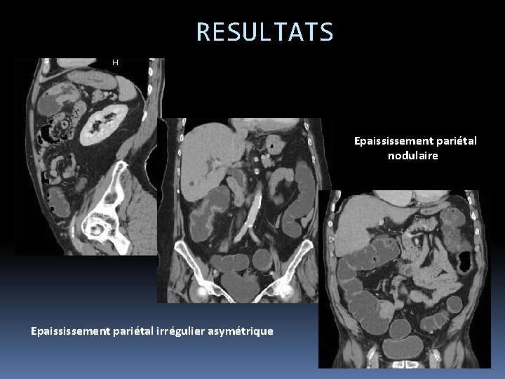 RESULTATS Epaississement pariétal nodulaire Epaississement pariétal irrégulier asymétrique 