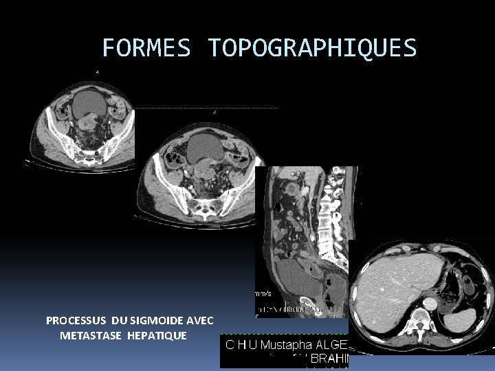 FORMES TOPOGRAPHIQUES PROCESSUS DU SIGMOIDE AVEC METASTASE HEPATIQUE 