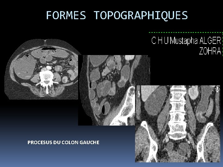 FORMES TOPOGRAPHIQUES PROCESUS DU COLON GAUCHE 