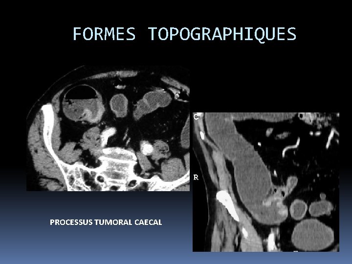 FORMES TOPOGRAPHIQUES PROCESSUS TUMORAL CAECAL 
