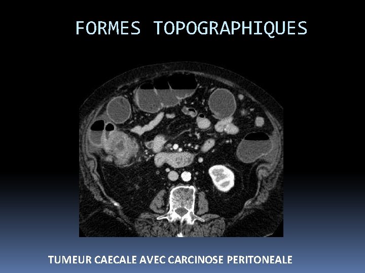 FORMES TOPOGRAPHIQUES TUMEUR CAECALE AVEC CARCINOSE PERITONEALE 