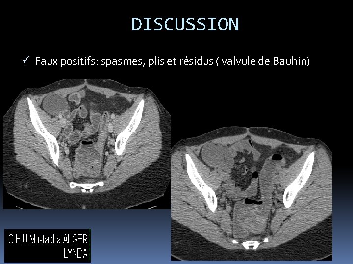 DISCUSSION ü Faux positifs: spasmes, plis et résidus ( valvule de Bauhin) 