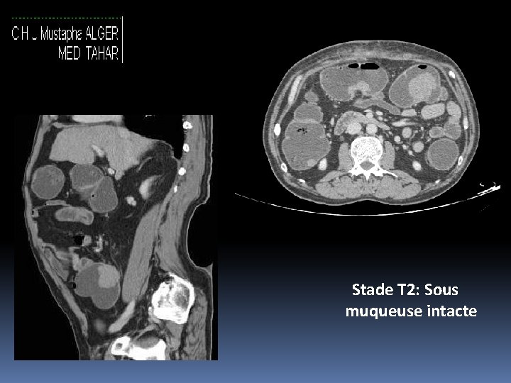 Stade T 2: Sous muqueuse intacte 