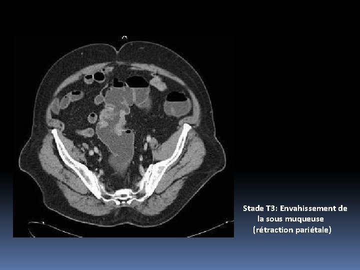 Stade T 3: Envahissement de la sous muqueuse (rétraction pariétale) 
